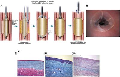 Recent Advances of Biomedical Materials for Prevention of Post-ESD Esophageal Stricture